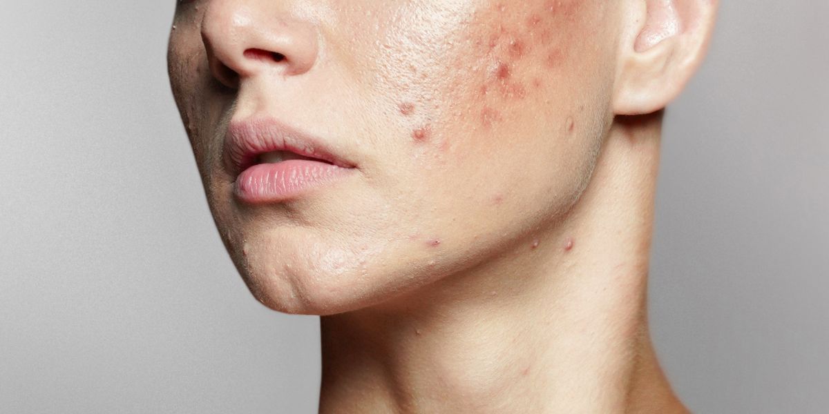 How to Treat Infected Pimples