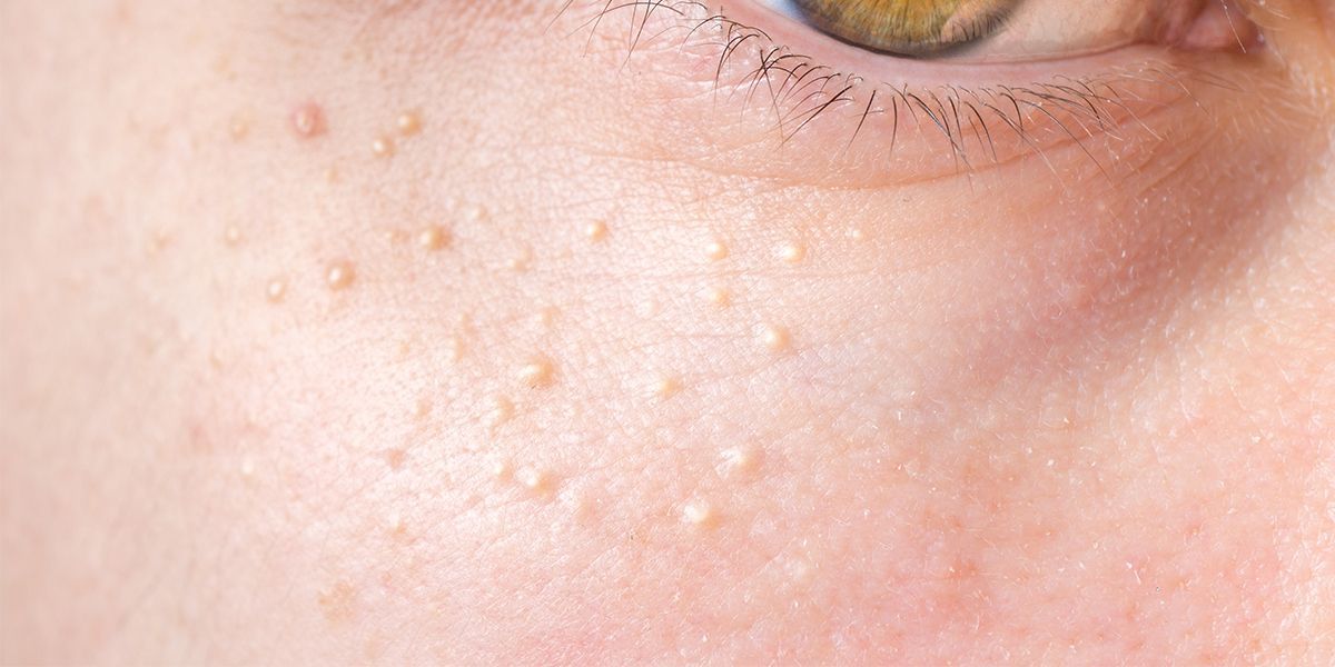 What Are Those Tiny Bumps On Your Face?