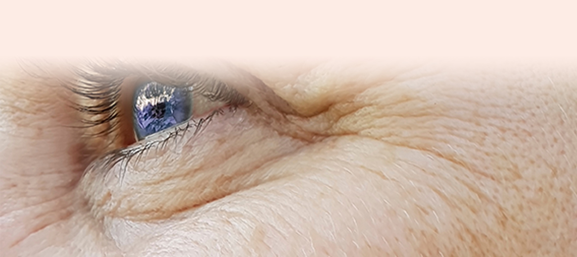Aging Skin