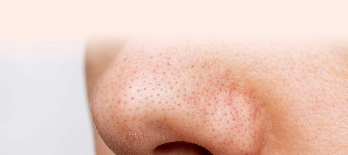 Blackheads