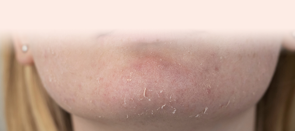 Dry Skin