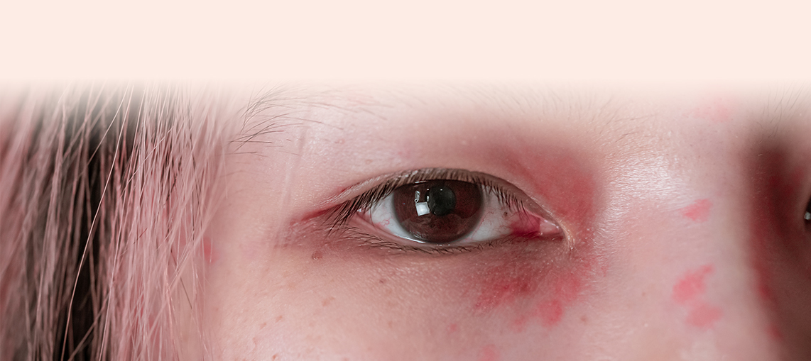 Irritated Skin